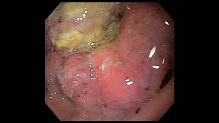 Carcinoma stomach [upl. by Atwahs]