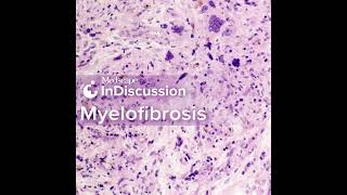 Transplant Tips Talks and Timing for Myelofibrosis [upl. by Creight]