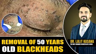 REMOVAL OF 50 YEARS OLD BLACKHEADS II Dr Lalit Kasanas [upl. by Tatia]