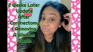 🦷Wisdom ToothCoronectomy  2 week Update 🦷😬 [upl. by Petulah]