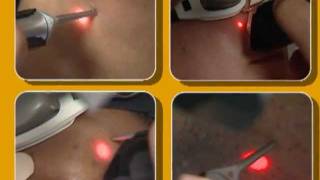 Laser Hair Removal video by Cynosure [upl. by Nyliak]