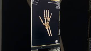 Ct Scan Wrist 3D 🫰 [upl. by Camila]