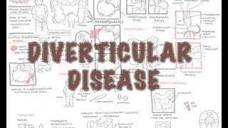 Diverticular Disease diverticulitis  Overview [upl. by Ymiaj]