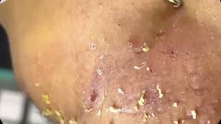 Remove ACNE FAST With These Treatment Secrets 165 [upl. by Anehsak]