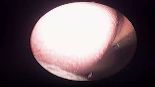 Sarika jain fiberoptic Laryngoscopy 23 07 2024 [upl. by Ahen74]