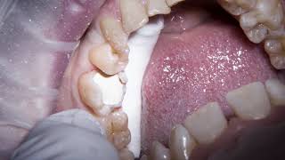 Biodentine  amalgam replacement on a large MOL cavity [upl. by Rudman]