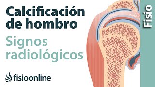 Calcificación de hombro en manguito rotador Signos radiológicos [upl. by Anaeed]