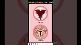 Normal vs Narrowed Stenosed Heart Valve education neet biology heart [upl. by Anahsak]