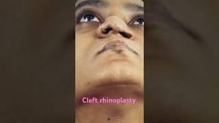 cleft rhinoplasty  World Class  Richardsons [upl. by Collar]