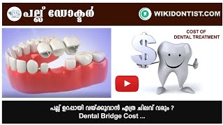 പല്ല് ഉറപ്പായി വയ്ക്കുവാൻ എത്ര ചിലവ് വരും Dental Bridge CostPart  1Video by DrThomas Nechupadam [upl. by Hellah]