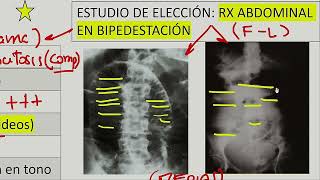 Cirugía general  Obstruccion intestinal ileo post operatorio volvulo instestinal [upl. by Atteynad875]