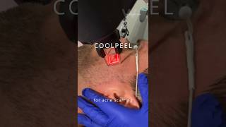 The CoolPeel Co2 Laser Treatment can get rid of deep acne scarring in just a few laser sessions [upl. by Yanffit]