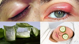 Effective Natural Home Remedies for Swollen Eyes  Home remedies Puffy eyes [upl. by Ellenhoj160]