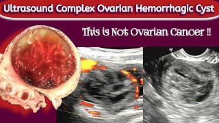 Ovarian Cyst with BLEED  TVS Ultrasound  Hemorrhagic Cyst [upl. by Conlan]