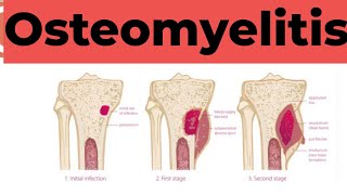 Osteomyelitis  Causes Sign and Symptoms Diagnosis amp Treatment Pathology [upl. by Babita]