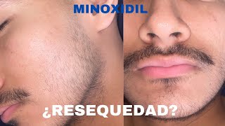 ¿CÓMO QUITAR LA RESEQUEDAD DEL MINOXIDIL EN LA BARBA [upl. by Roxine728]