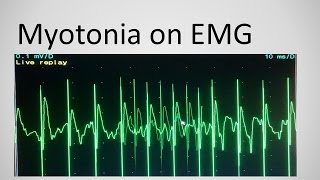 Myotonia on EMG [upl. by Darrey]