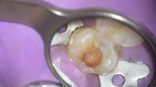 Premolar Root Canal Purulent Exudate [upl. by Hteik463]