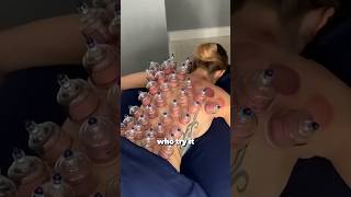 Cupping Therapy Explanation [upl. by Aiuqes980]