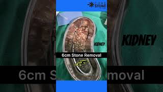 How 6cm stone from kidney looks after removal MiniPCNL RIRS…Laser kidney stones viral trending [upl. by Clarisa869]