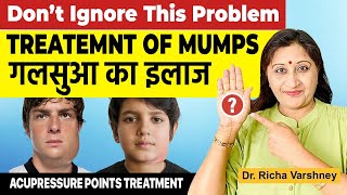 Mumps Treatment In Hindi  Acupressure Points For Mumps [upl. by Ahsinal]