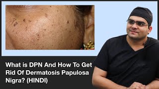 What is DPN And How To Get Rid Of Dermatosis Papulosa Nigra  ClearSkin Pune  In HINDI [upl. by Ahsenod903]