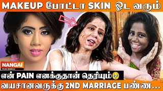 வெயில் தாங்காம கண்ணாடியில படுப்பேன் 😓 Ramya Vitiligo Model Opens Up  Rednool Nangai [upl. by Audley]