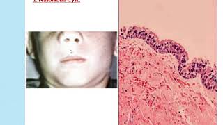 Cysts 2 Non odontogenic cysts [upl. by Caron]