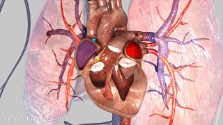 Atrial Fibrillation Animation [upl. by Niasuh]