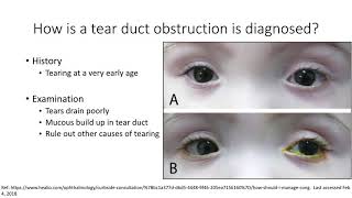 AAPOS Nasolacrimal Duct Obstruction [upl. by Biggs502]