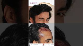 The Best Hair Transplant Results by Dr Suneet Soni at Medispa Hair Transplant Centre FUT  FUE combo [upl. by Tori]