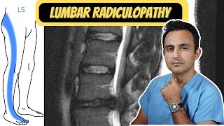 Lumbar Radiculopathy quotSciaticaquot [upl. by Ellertal]