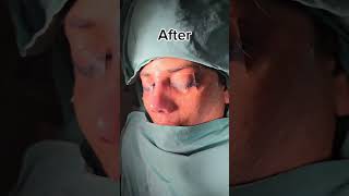 Revision Rhinoplasty [upl. by Avrom]