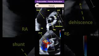 Endocarditis  Perforation  Fistula [upl. by Bartholomew73]