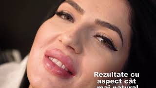 Buze mărite cu aspect natural cu acid hialuronic Juvederm 💋Augmentare buze💋SKiN BucureștiampCorbeanca [upl. by Godliman675]