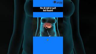 Gall bladder stone removal  Laproscopic Cholecystectomy  shortsviral [upl. by Barra]