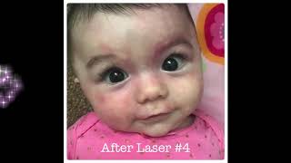 Tiny But Mighty Bink  Pulsed Dye Laser Progression 2018 [upl. by Angel]