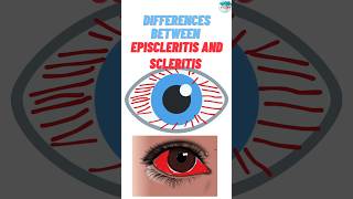 What are the Differences Between Episcleritis and Scleritis rheumatoidarthritisautoimmunediseases [upl. by Atarman606]