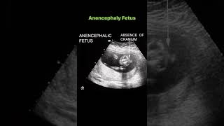 Anencephaly Fetus [upl. by Melvin]