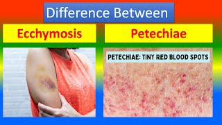 Distinction Between Ecchymosis and Petechiae [upl. by Naujal]