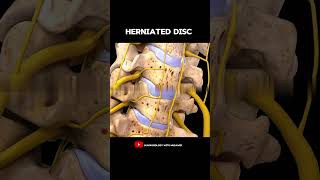 Spine model  Herniated disc  Anatomy [upl. by Ahsrop277]