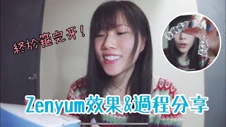 箍完zenyum牙套分享  我的箍牙日記 EP4 [upl. by Selij]