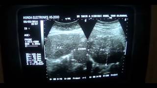 PREGNANCY with FIBROIDS [upl. by Alimrahs]