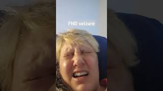 FND seizure aka non epileptic seizure functional neurological disorder [upl. by Aileme]