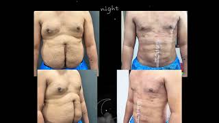 Liposuction before After Results  vaser Liposuction Results lahore pakistan draminyousaf [upl. by Oirasor285]