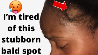 How to regrow “Stubborn” bald spot on hairline 🙄 regrow stubborn bald spot on edges  bald spot [upl. by Liw]