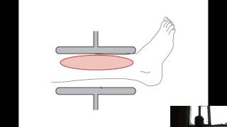 Shortwave Diathermy [upl. by Sivrup]