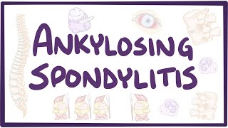 Ankylosing spondylitis  causes symptoms diagnosis treatment pathology [upl. by Sverre]