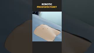 ROBOTIC PROSTATECTOMY [upl. by Paulie]