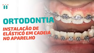 Dica de Ortodontia Como instalar o Elástico em Cadeia no Aparelho de 1o molar a 1 molar inferior [upl. by Helfant]